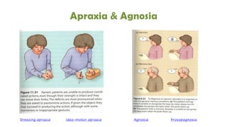 Dressing apraxia Ideo-motor apraxia Agnosia Prosopagnosia
 