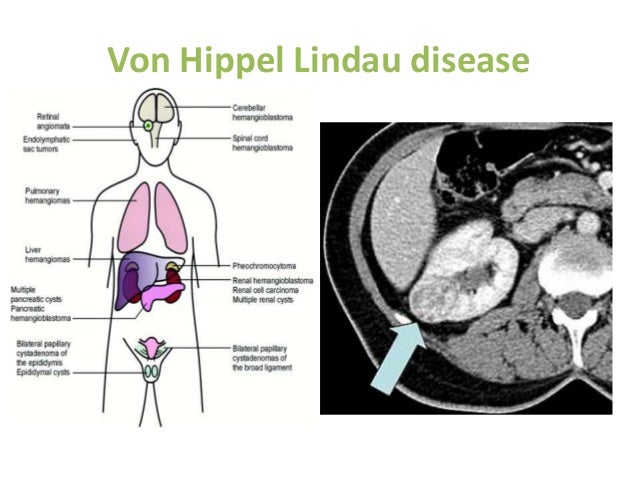 interventional radiology in cancer