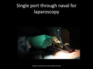 Single port through naval for laparoscopy Surgisil, innovation licensed by NCIIA Grantee