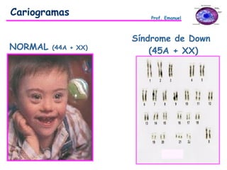 NORMAL (44A + XX)
Síndrome de Down
(45A + XX)
Cariogramas Prof. Emanuel
 