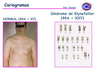 Síndrome de Klynefelter
(44A + XXY)NORMAL (44A + XY)
Cariogramas Prof. Emanuel
 