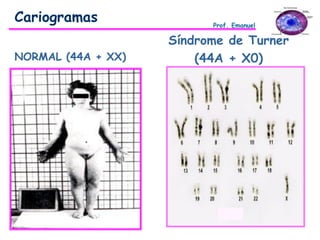 NORMAL (44A + XX)
Síndrome de Turner
(44A + X0)
Cariogramas Prof. Emanuel
 