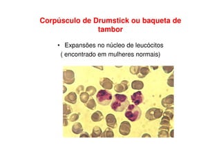 Corpúsculo de Drumstick ou baqueta de
               tambor

    • Expansões no núcleo de leucócitos
     ( encontrado em mulheres normais)
 