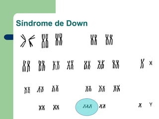 Síndrome de Down
 