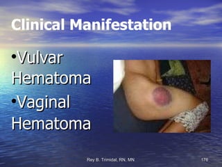 Clinical Manifestation Vulvar Hematoma Vaginal Hematoma 