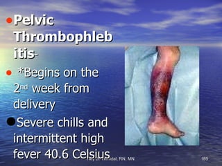 Pelvic Thrombophlebitis -  *Begins on the 2 nd  week from delivery Severe chills and intermittent high fever 40.6 Celsius 