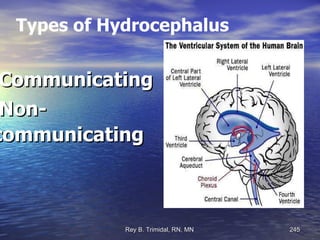 Types of Hydrocephalus Communicating Non-communicating 