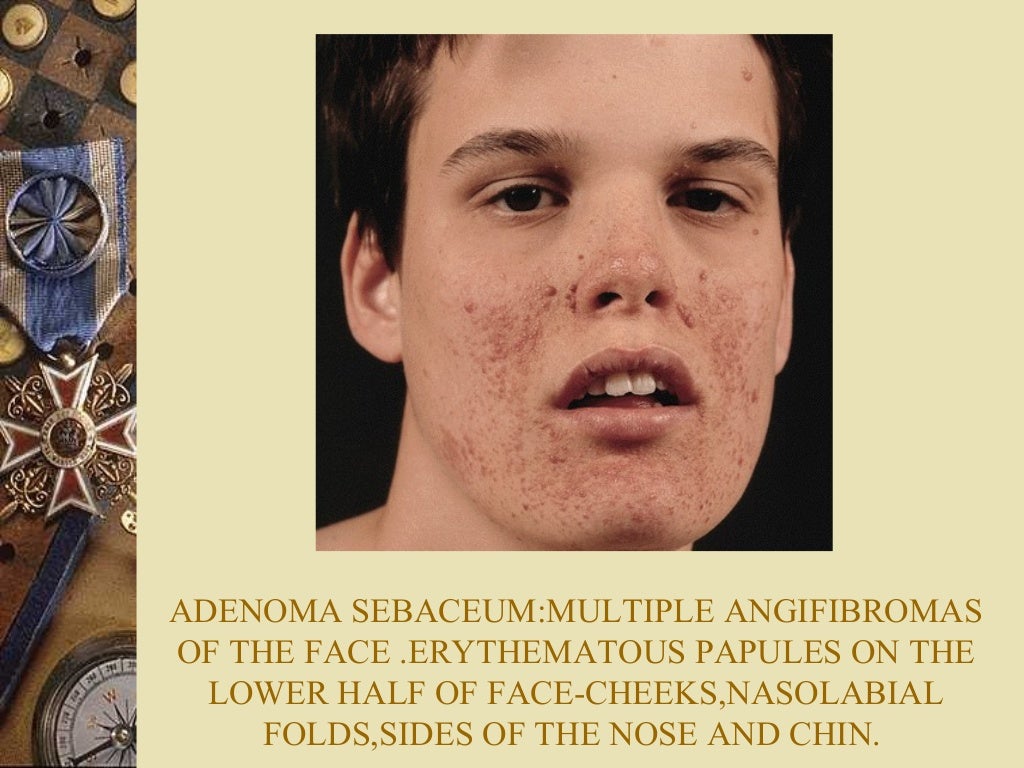 neuro cutaneous markers