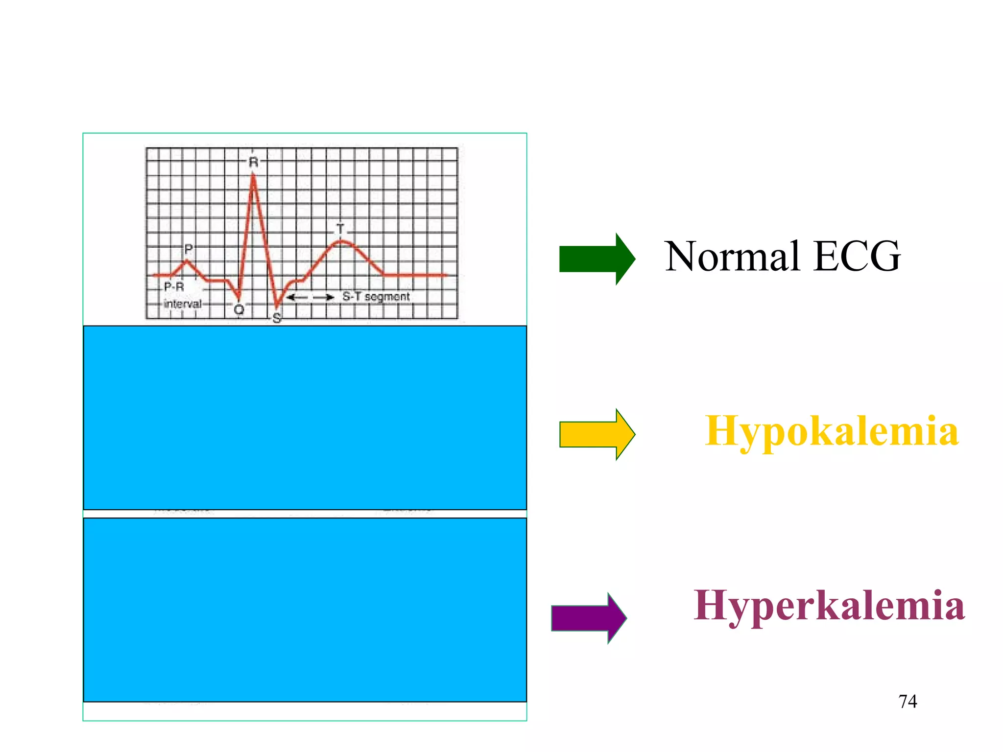   Normal ECG Hypokalemia Hyperkalemia 
