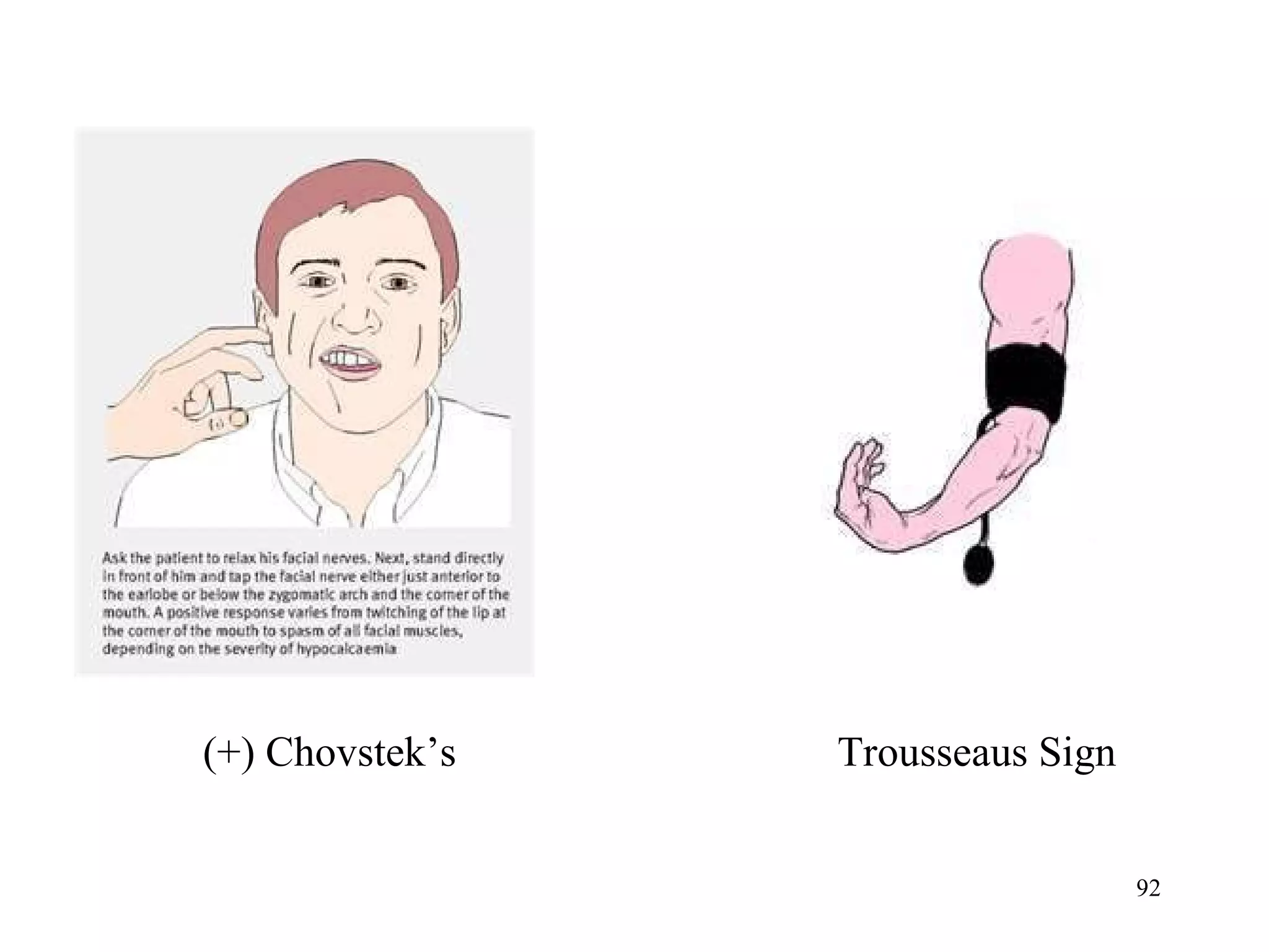 (+) Chovstek’s Trousseaus Sign 