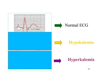   Normal ECG Hypokalemia Hyperkalemia 