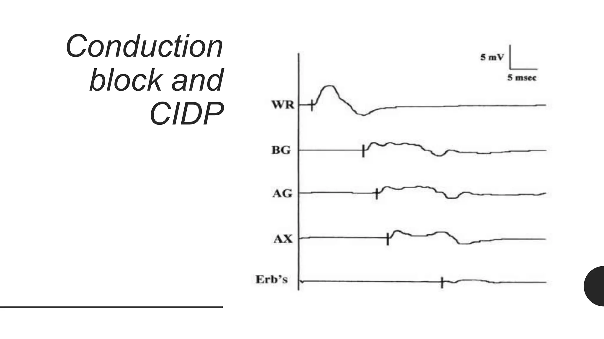 Conduction
block and
CIDP
 