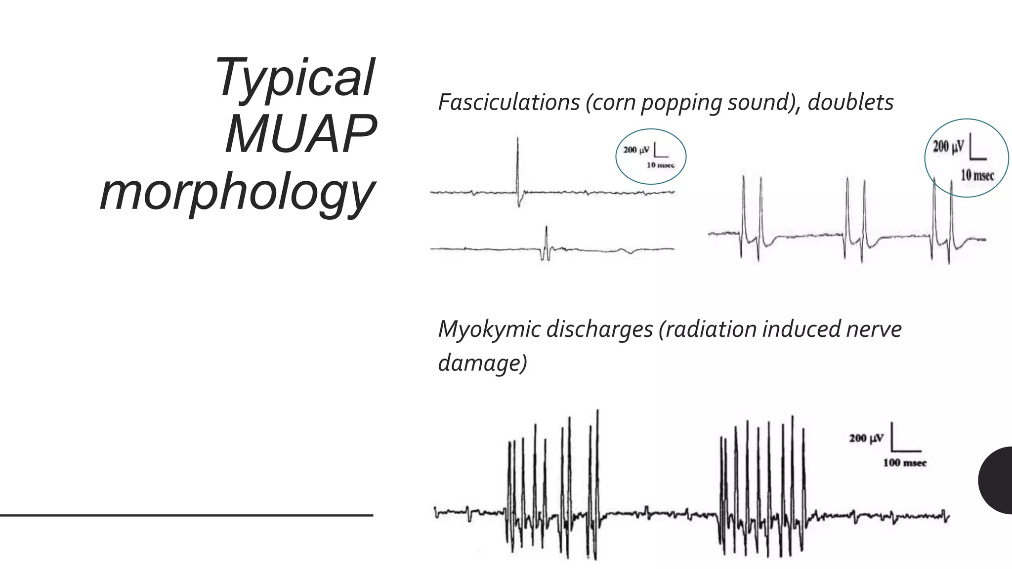 Typical
MUAP
morphology
Fasciculations (corn popping sound), doublets
Myokymic discharges (radiation induced nerve
damage)
 