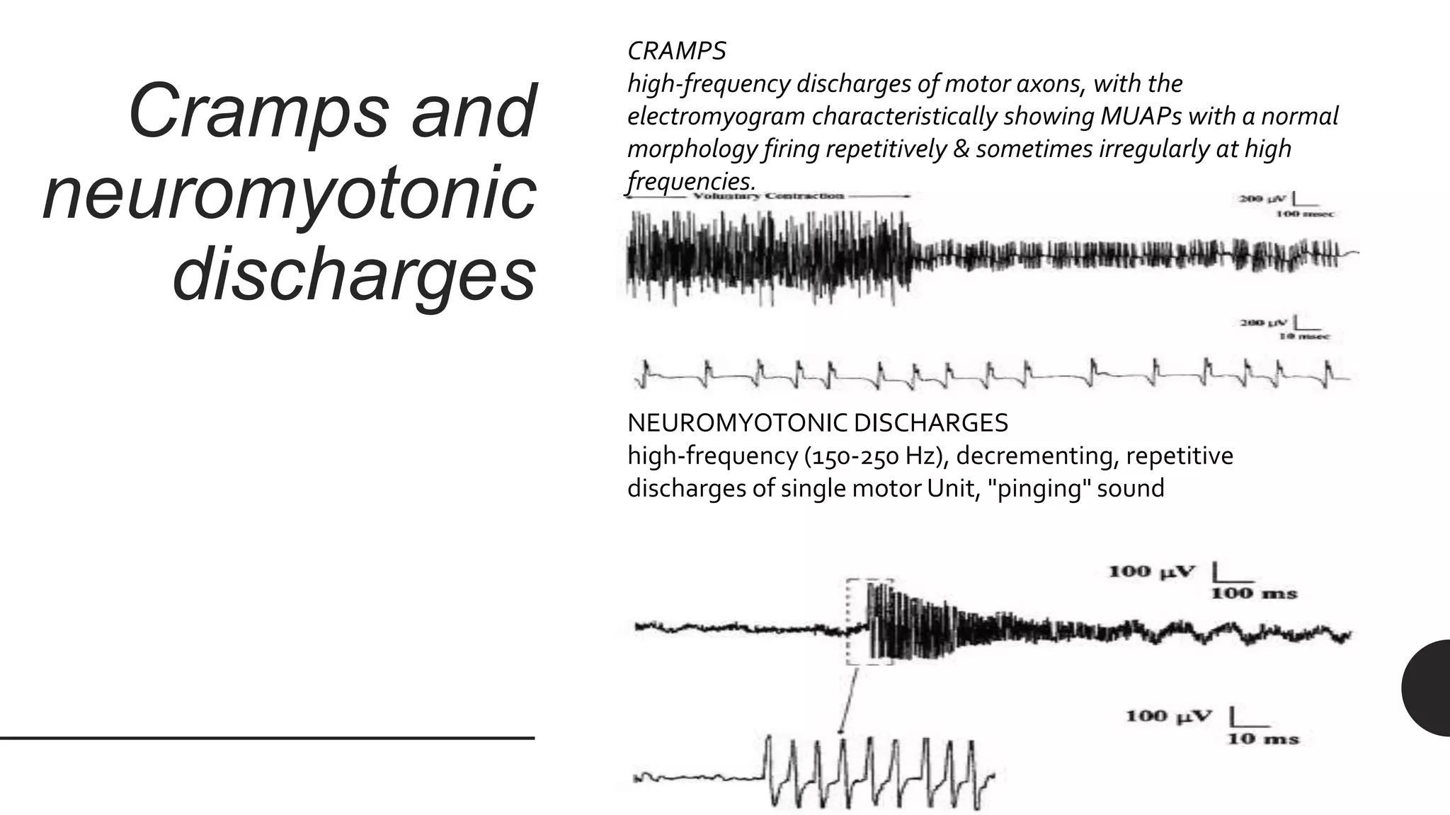Cramps and
neuromyotonic
discharges
NEUROMYOTONIC DISCHARGES
high-frequency (150-250 Hz), decrementing, repetitive
discharges of single motor Unit, "pinging" sound
CRAMPS
high-frequency discharges of motor axons, with the
electromyogram characteristically showing MUAPs with a normal
morphology firing repetitively & sometimes irregularly at high
frequencies.
 