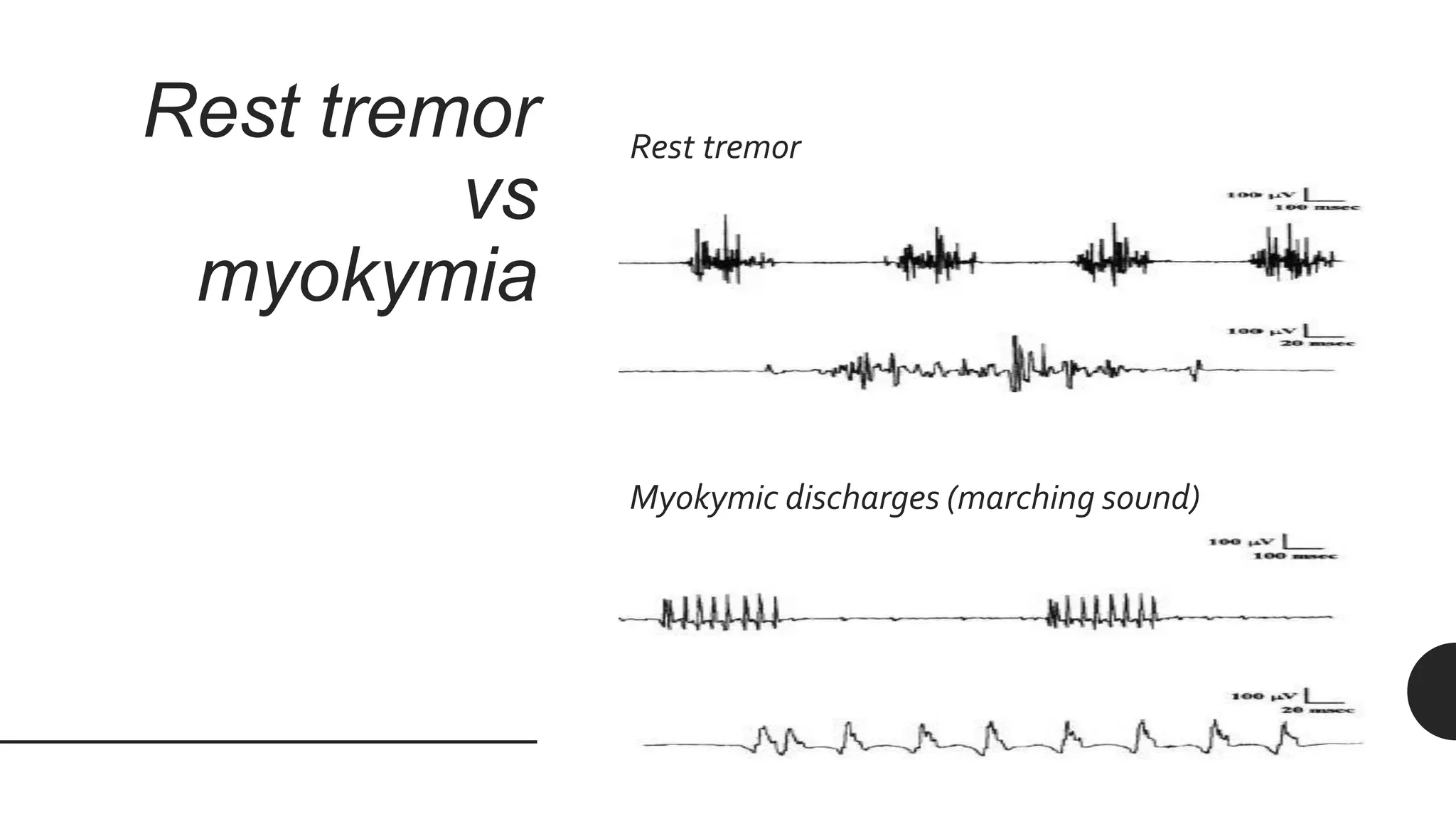 Rest tremor
vs
myokymia
Rest tremor
Myokymic discharges (marching sound)
 