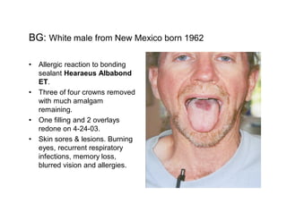 BG: White male from New Mexico born 1962

  Allergic reaction to bonding
  sealant Hearaeus Albabond
  ET.
  Three of four crowns removed
  with much amalgam
  remaining.
  One filling and 2 overlays
  redone on 4-24-03.
  Skin sores & lesions. Burning
  eyes, recurrent respiratory
  infections, memory loss,
  blurred vision and allergies.
 