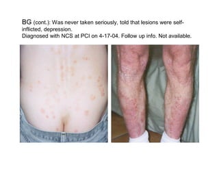 BG (cont.): Was never taken seriously, told that lesions were self-
inflicted, depression.
Diagnosed with NCS at PCI on 4-17-04. Follow up info. Not available.
 