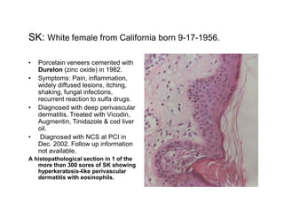 SK: White female from California born 9-17-1956.

   Porcelain veneers cemented with
   Durelon (zinc oxide) in 1982.
   Symptoms: Pain, inflammation,
   widely diffused lesions, itching,
   shaking, fungal infections,
   recurrent reaction to sulfa drugs.
   Diagnosed with deep perivascular
   dermatitis. Treated with Vicodin,
   Augmentin, Tinidazole & cod liver
   oil.
    Diagnosed with NCS at PCI in
   Dec. 2002. Follow up information
   not available.
A histopathological section in 1 of the
   more than 300 sores of SK showing
   hyperkeratosis-like perivascular
   dermatitis with eosinophils.
 
