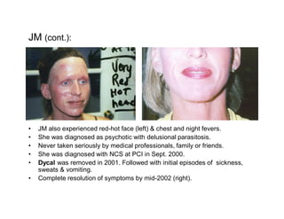 JM (cont.):




  JM also experienced red-hot face (left) & chest and night fevers.
  She was diagnosed as psychotic with delusional parasitosis.
  Never taken seriously by medical professionals, family or friends.
  She was diagnosed with NCS at PCI in Sept. 2000.
  Dycal was removed in 2001. Followed with initial episodes of sickness,
  sweats & vomiting.
  Complete resolution of symptoms by mid-2002 (right).
 