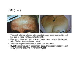 KMc (cont.):




  The rash later developed into elevated sores accompanied by red
  hot skin in head (left) and chest (right).
  KMc was diagnosed with scabies (never demonstrated) & treated
  with Elimite, Ivermectin and herbs.
  She was diagnosed with NCS at PCI on 11-19-02.
  Dycal was removed in December, 2002. Progressive resolution of
  all symptoms following removal of Dycal.
 