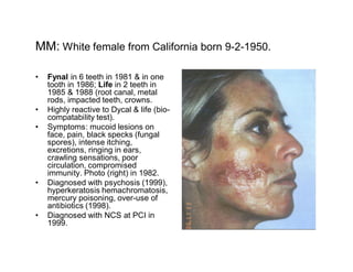MM: White female from California born 9-2-1950.

  Fynal in 6 teeth in 1981 & in one
  tooth in 1986; Life in 2 teeth in
  1985 & 1988 (root canal, metal
  rods, impacted teeth, crowns.
  Highly reactive to Dycal & life (bio-
  compatability test).
  Symptoms: mucoid lesions on
  face, pain, black specks (fungal
  spores), intense itching,
  excretions, ringing in ears,
  crawling sensations, poor
  circulation, compromised
  immunity. Photo (right) in 1982.
  Diagnosed with psychosis (1999),
  hyperkeratosis hemachromatosis,
  mercury poisoning, over-use of
  antibiotics (1998).
  Diagnosed with NCS at PCI in
  1999.
 