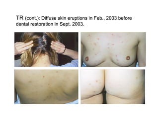 TR (cont.): Diffuse skin eruptions in Feb., 2003 before
dental restoration in Sept. 2003.
 
