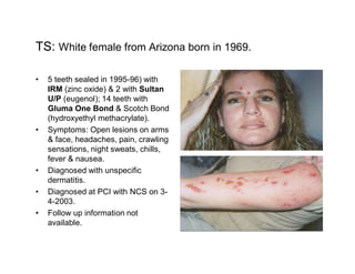 TS: White female from Arizona born in 1969.

  5 teeth sealed in 1995-96) with
  IRM (zinc oxide) & 2 with Sultan
  U/P (eugenol); 14 teeth with
  Gluma One Bond & Scotch Bond
  (hydroxyethyl methacrylate).
  Symptoms: Open lesions on arms
  & face, headaches, pain, crawling
  sensations, night sweats, chills,
  fever & nausea.
  Diagnosed with unspecific
  dermatitis.
  Diagnosed at PCI with NCS on 3-
  4-2003.
  Follow up information not
  available.
 