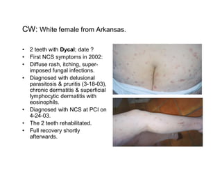 CW: White female from Arkansas.

  2 teeth with Dycal; date ?
  First NCS symptoms in 2002:
  Diffuse rash, itching, super-
  imposed fungal infections.
  Diagnosed with delusional
  parasitosis & pruritis (3-18-03),
  chronic dermatitis & superficial
  lymphocytic dermatitis with
  eosinophils.
  Diagnosed with NCS at PCI on
  4-24-03.
  The 2 teeth rehabilitated.
  Full recovery shortly
  afterwards.
 
