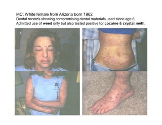 MC: White female from Arizona born 1962
Dental records showing compromising dental materials used since age 6.
Admitted use of weed only but also tested positive for cocaine & crystal meth.
 