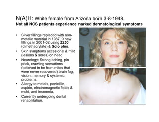 N(A)H: White female from Arizona born 3-8-1948.
Not all NCS patients experience marked dermatological symptoms

  Silver fillings replaced with non-
  metalic material in 1987. 9 new
  fillings in 2001-02 using Z250
  (dimethacrylate) & Solo plus.
  Skin symptoms occasional & mild
  (lesions & sores) on head.
  Neurology: Strong itching, pin
  prick, crawling sensations
  (believed to be from mites that
  were never recovered) brain fog,
  vision, memory & systemic
  problems.
  Allergy to metals, penicillin,
  aspirin, electromagnetic fields &
  mold, and insomnia.
  Currently undergoing dental
  rehabilitation.
 