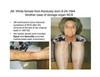 JM: White female from Kentucky born 6-24-1944
           Another case of storage organ NCS

  JM continued to have classical
  symptoms of NCS after the
  removal of the last of her original
  teeth in 1991/92.
  Her earlier dental work included
  Dycal and Herculite (uncured
  methacrylate ester monomers).
 