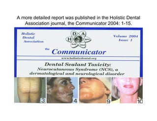 A more detailed report was published in the Holistic Dental
   Association journal, the Communicator 2004: 1-15.
 
