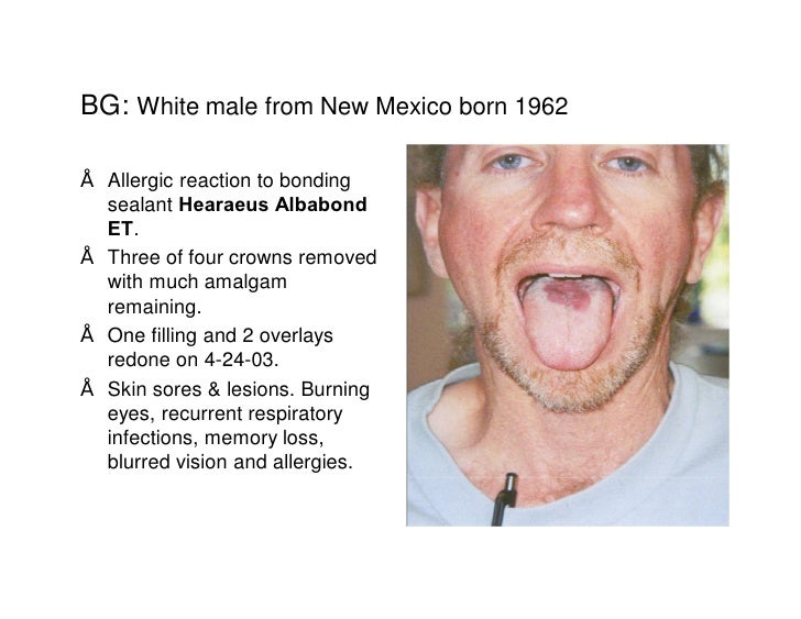 Morgellons (Nuero Cutaneous Syndrome) Disease, Treatment & Cure