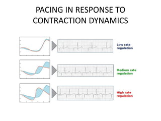 PACING IN RESPONSE TO
CONTRACTION DYNAMICS
 