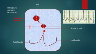 Narrow complex tachycardia/supraventricular tachycardia | PPTX