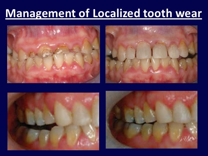 NonCarious Tooth Substance Loss