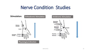 Nerve Condition Studies
Stimulation:
EMG & NCV 19
Orthodromic Stimulation Antidromic Stimulation
Physiological direction
 