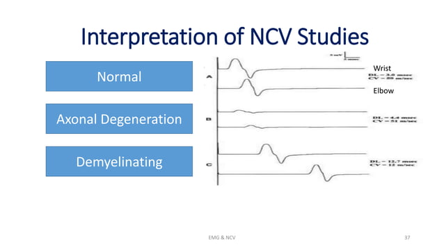 NCV and EMG.pptx | Brain and Nervous System Disorders | Diseases and ...