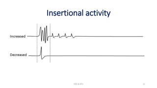 Insertional activity
EMG & NCV 51
 