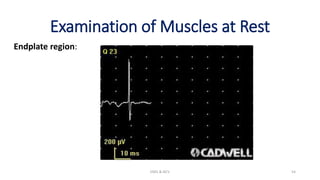 Examination of Muscles at Rest
Endplate region:
EMG & NCV 54
 