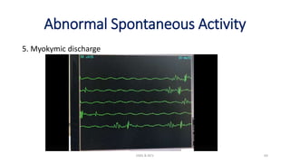 Abnormal Spontaneous Activity
5. Myokymic discharge
EMG & NCV 64
 