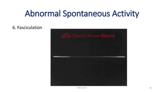 Abnormal Spontaneous Activity
6. Fasciculation
EMG & NCV 66
 
