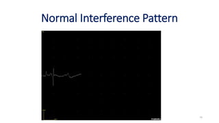 Normal Interference Pattern
EMG & NCV 74
 