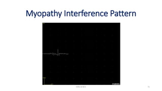 Myopathy Interference Pattern
EMG & NCV 75
 