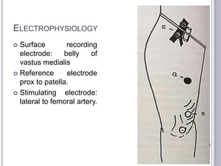 ELECTROPHYSIOLOGY 
 Surface recording 
electrode: belly of 
vastus medialis 
 Reference electrode 
prox to patella. 
 Stimulating electrode: 
lateral to femoral artery. 
 