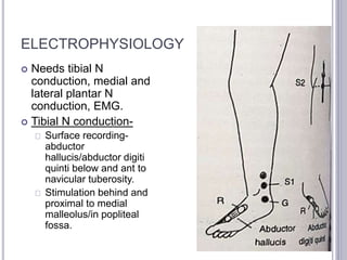 ELECTROPHYSIOLOGY 
 Needs tibial N 
conduction, medial and 
lateral plantar N 
conduction, EMG. 
 Tibial N conduction- 
Surface recording-abductor 
hallucis/abductor digiti 
quinti below and ant to 
navicular tuberosity. 
Stimulation behind and 
proximal to medial 
malleolus/in popliteal 
fossa. 
 