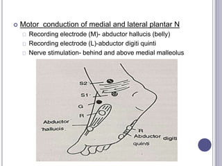  Motor conduction of medial and lateral plantar N 
Recording electrode (M)- abductor hallucis (belly) 
Recording electrode (L)-abductor digiti quinti 
Nerve stimulation- behind and above medial malleolus 
 
