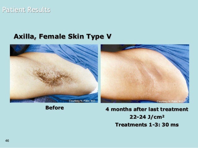 Nd Yag Laser Hair Reduction