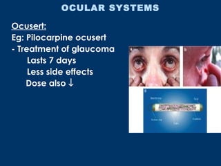 Ocuset Formulation Newer drug delivery systems | PPT