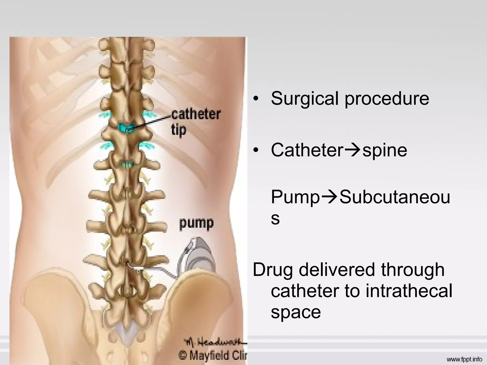 • Surgical procedure
• Catheterspine
PumpSubcutaneou
s
Drug delivered through
catheter to intrathecal
space